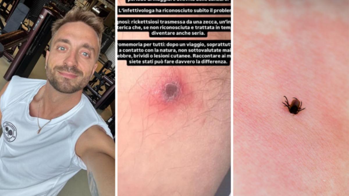 rickettsiosi cos 232 l infezione che ha contratto stefano corti a causa di una zecca da Gazzetta.it rickettsiosi cos 232 l infezione che ha contratto stefano corti a causa di una zecca