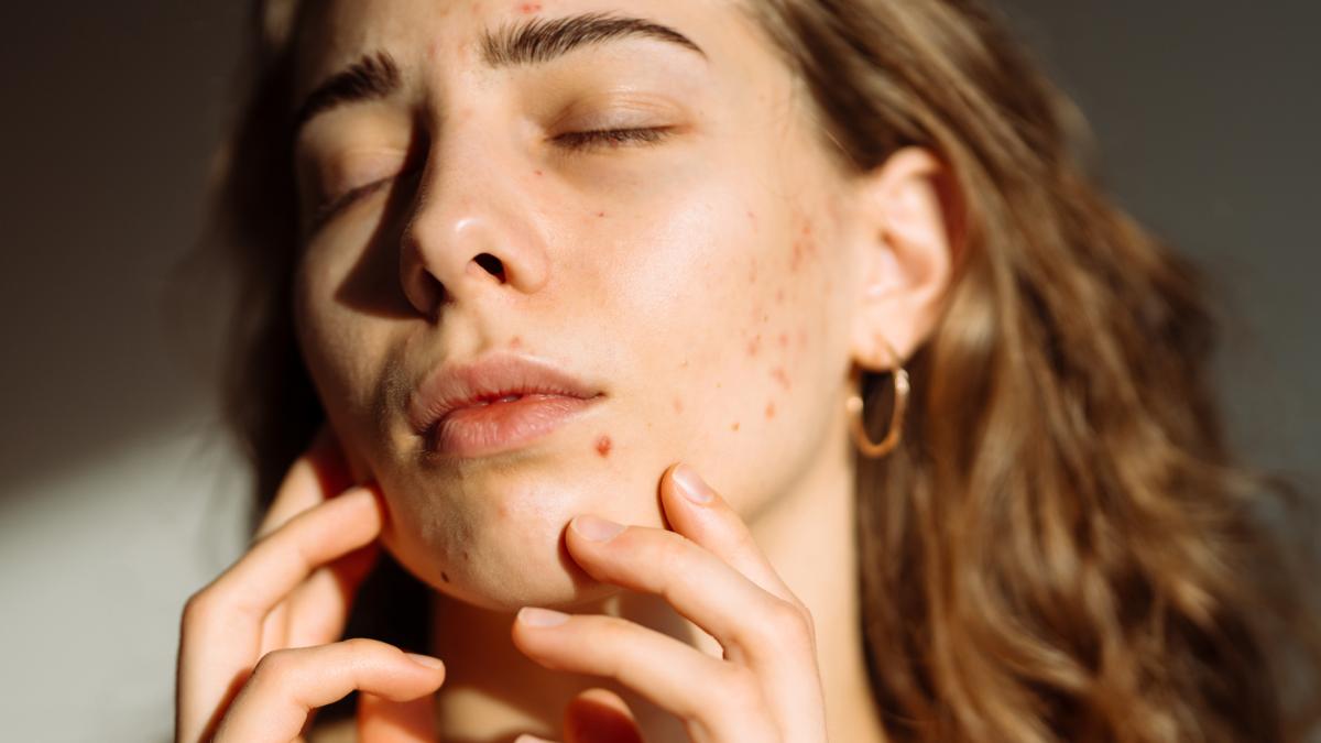 Perché l’acne peggiora d’estate? Come comportarsi per gestirla col caldo? Parla l’esperto