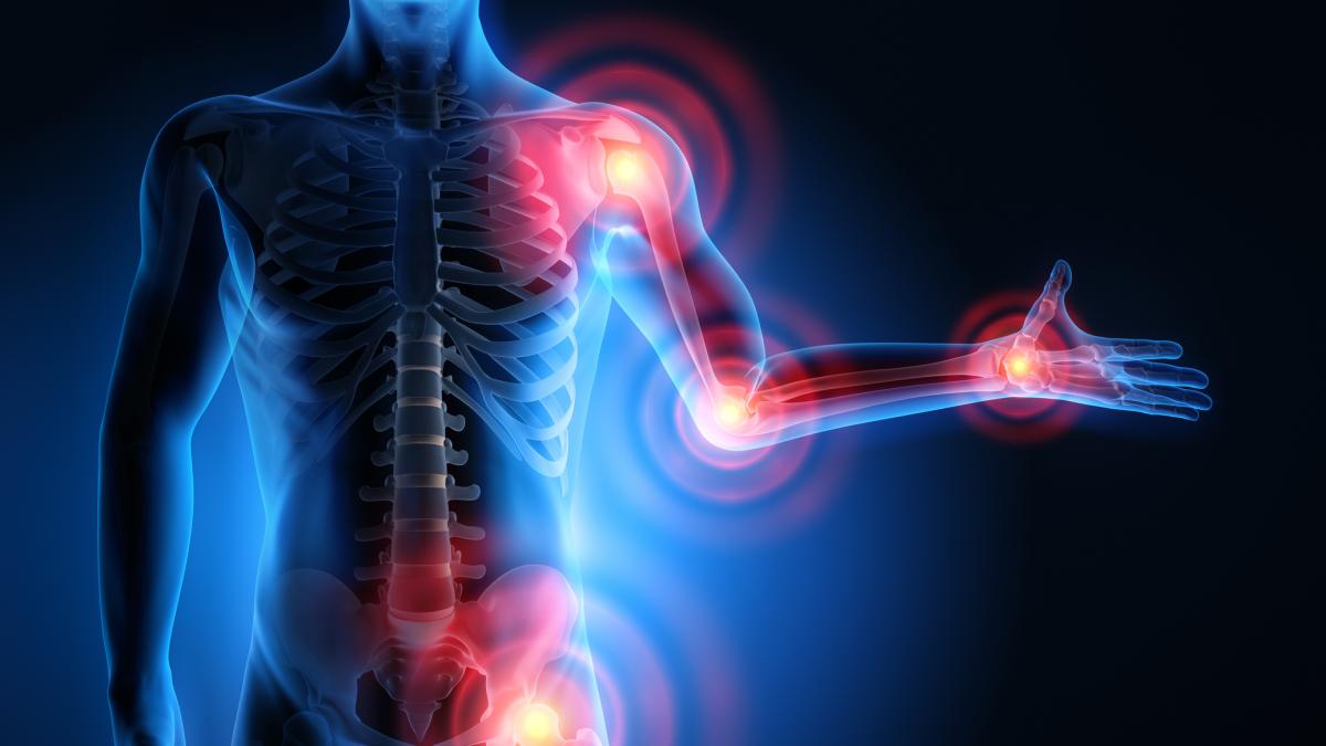 osteoartrite tra nuovi farmaci e ginocchia in 3d gli usa sperimentano una nuova cura da Gazzetta.it osteoartrite tra nuovi farmaci e ginocchia in 3d gli usa sperimentano una nuova cura