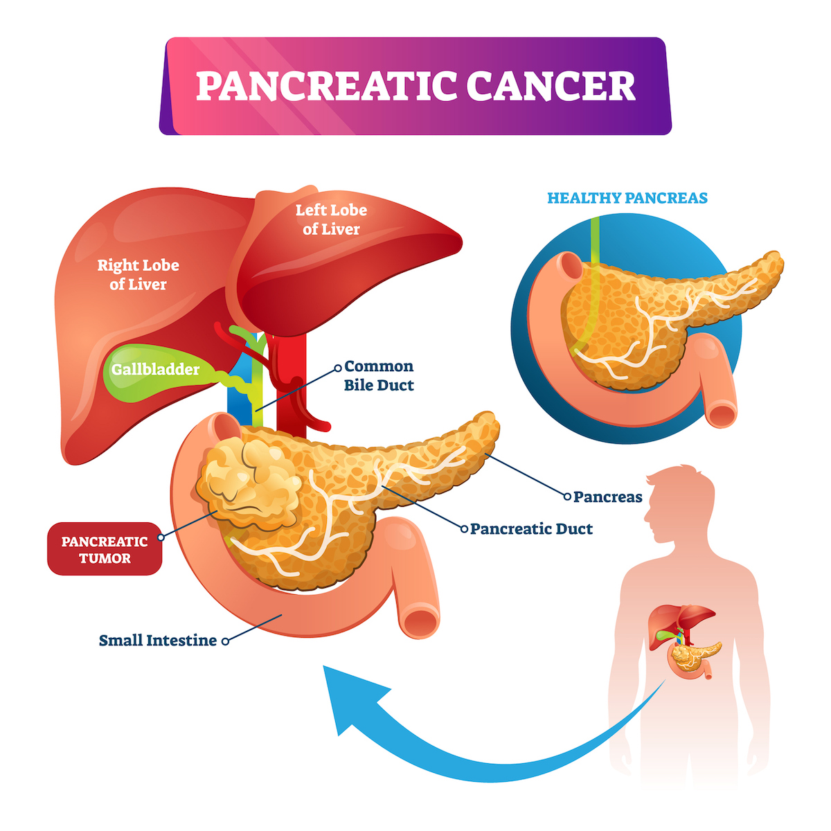 Tumore al pancreas metastasi e sopravvivenza