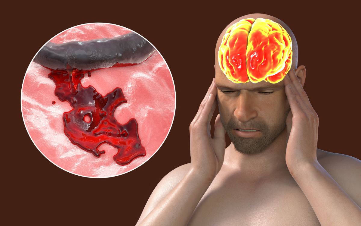 Emorragia cerebrale sintomi, cause, perché si può morire, conseguenze Gazzetta.it
