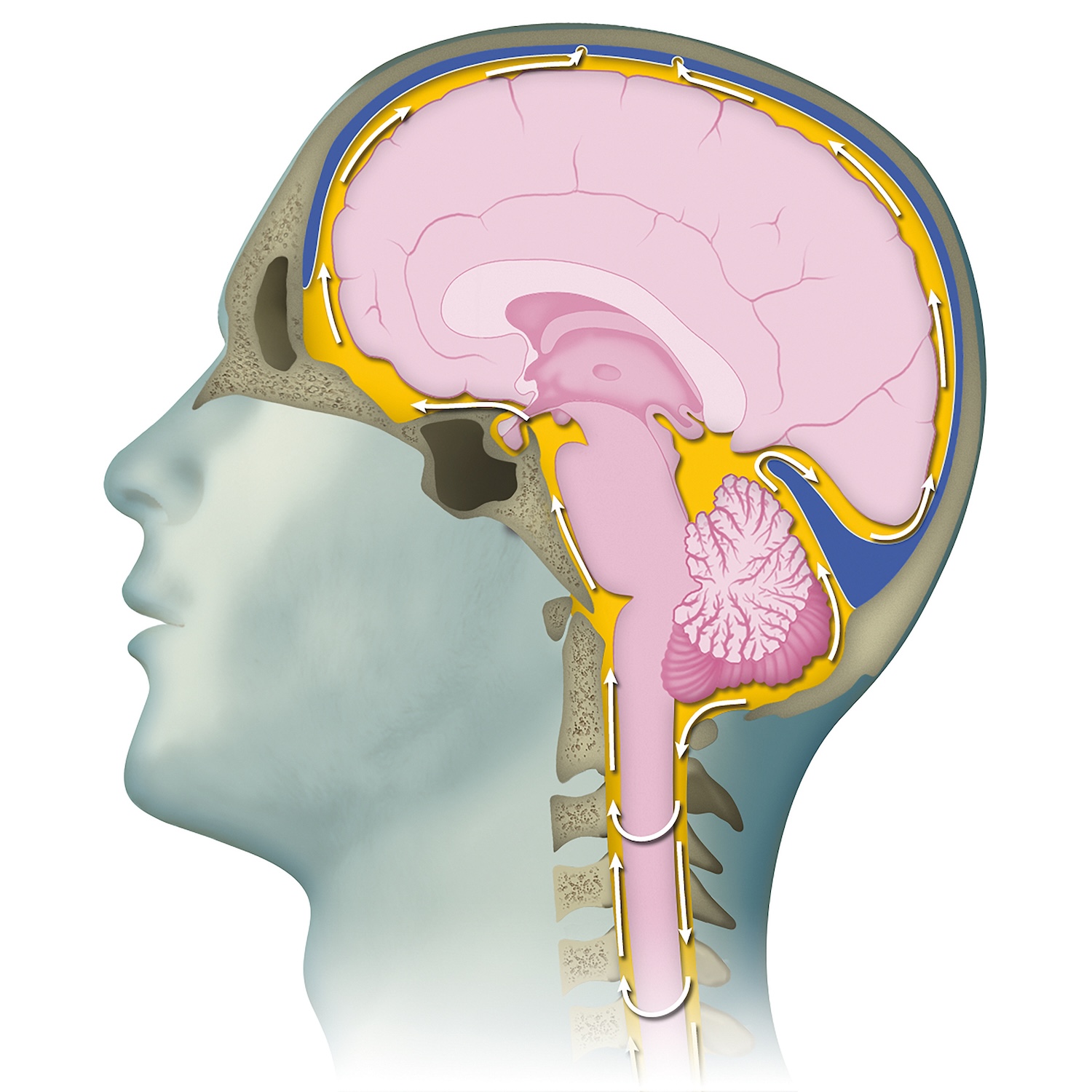 Perdita di liquido cerebrospinale: come non confonderla con un raffreddore