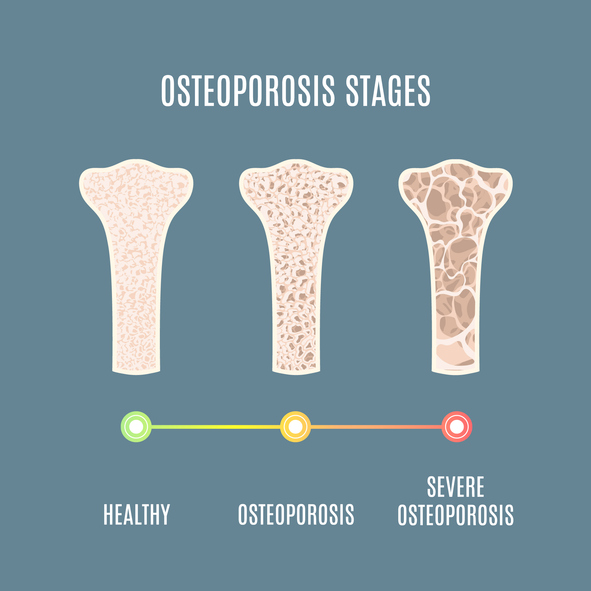 Osteoporosi