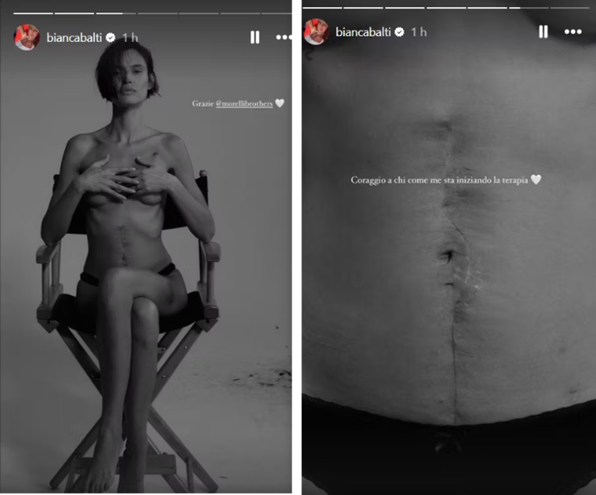 Bianca Balti topless e cicatrici