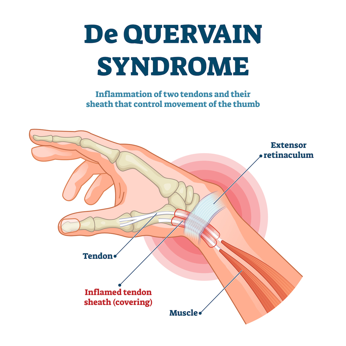 Sindrome di De Quervain sintomi e terapia