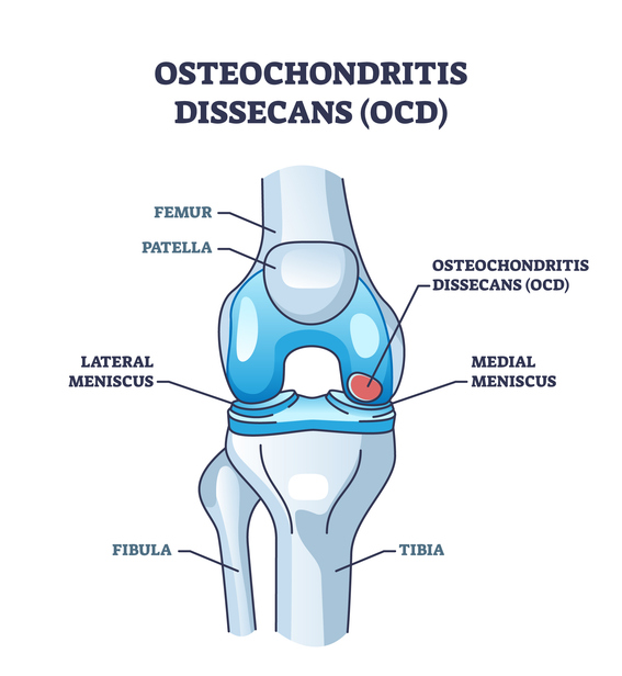 Osteocondrite dissecante