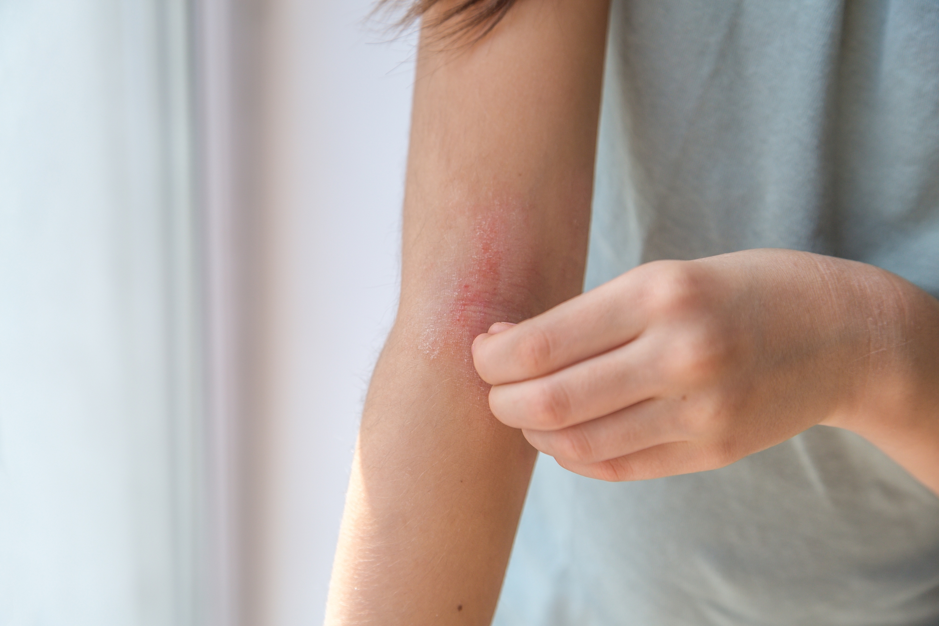Dermatofilosi Malattia Della Pioggia Sintomi Contagio Cure E Rischi dermatofilosi-malattia-della-pioggia-sintomi-contagio-cure-e-rischi