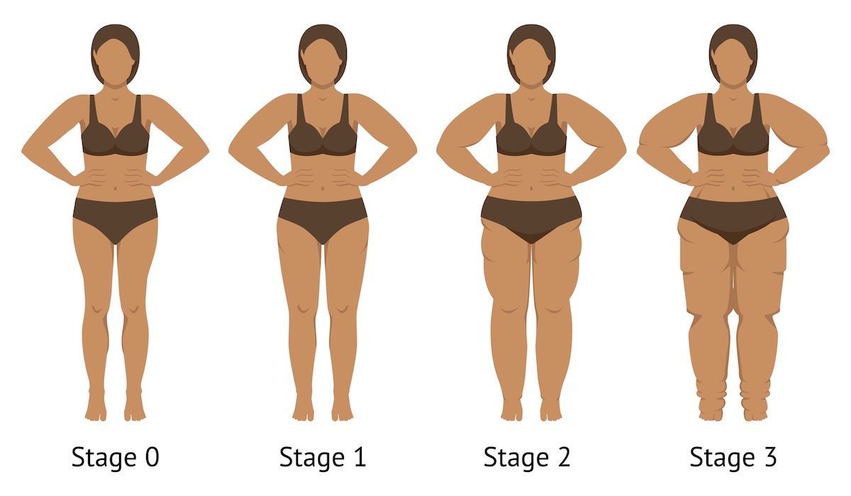 Lipedema sintomi